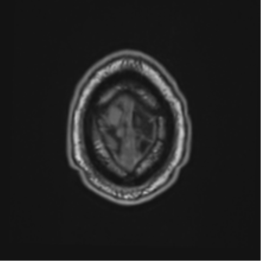 File:Atypical meningioma (WHO grade II) with brain invasion (Radiopaedia 57767-64729 Axial T1 49).png