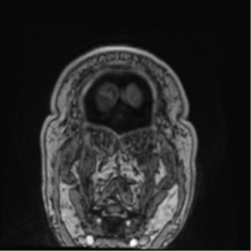 Atypical meningioma (WHO grade II) with brain invasion (Radiopaedia 57767-64729 Coronal T1 C+ 83).png