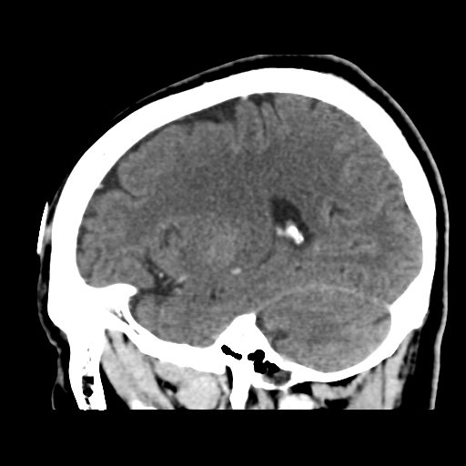 Atypical meningioma (WHO grade II) with osseous invasion (Radiopaedia 53654-59715 G 38).png