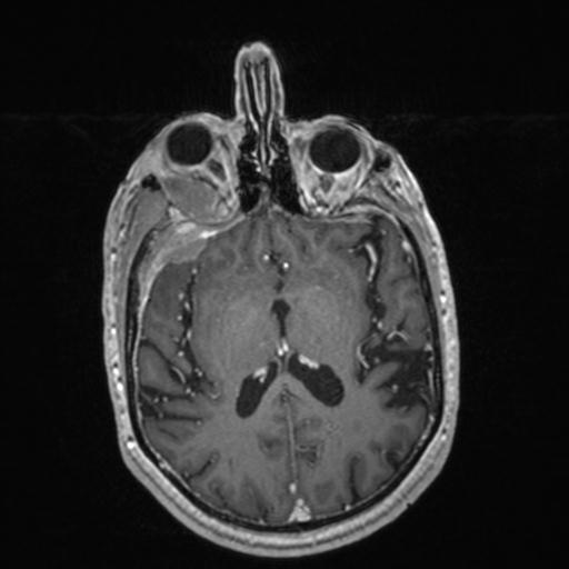 Atypical meningioma (grade II) - en plaque (Radiopaedia 29633-30147 Axial T1 C+ 101).jpg