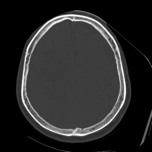 File:Atypical meningioma with skull invasion (Radiopaedia 34357-35649 Axial bone window 59).png
