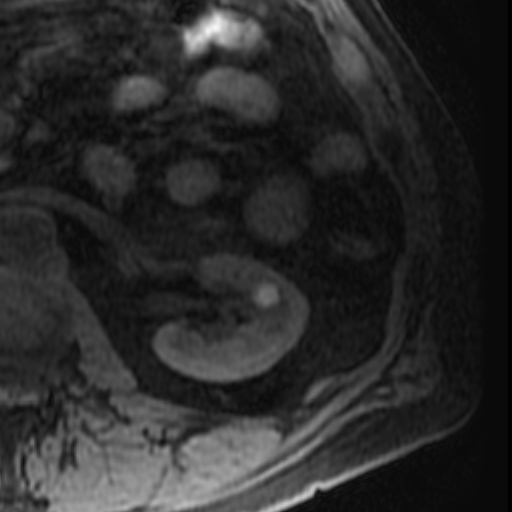 File:Atypical renal cyst on MRI (Radiopaedia 17349-17046 Axial T1 fat sat 19).jpg