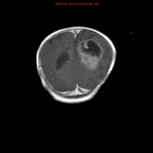 File:Atypical teratoid rhabdoid tumor (Radiopaedia 10712-11183 Coronal T1 C+ 3).jpg