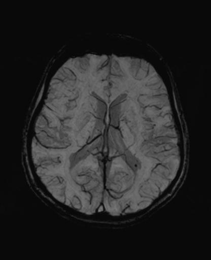 Autoimmune limbic encephalitis (Radiopaedia 30363-31005 SWI - mIP 41).jpg