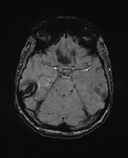 Autoimmune limbic encephalitis (Radiopaedia 30363-31005 SWI 27).jpg