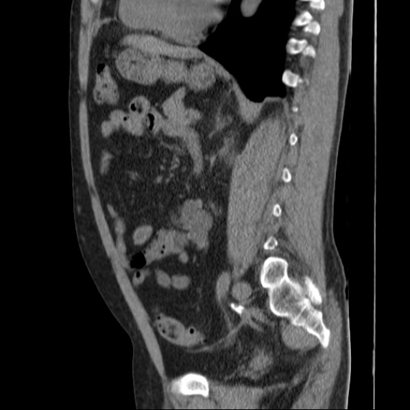 File:Autosomal dominant polycystic kidney disease (Radiopaedia 36539-38101 D 51).jpg