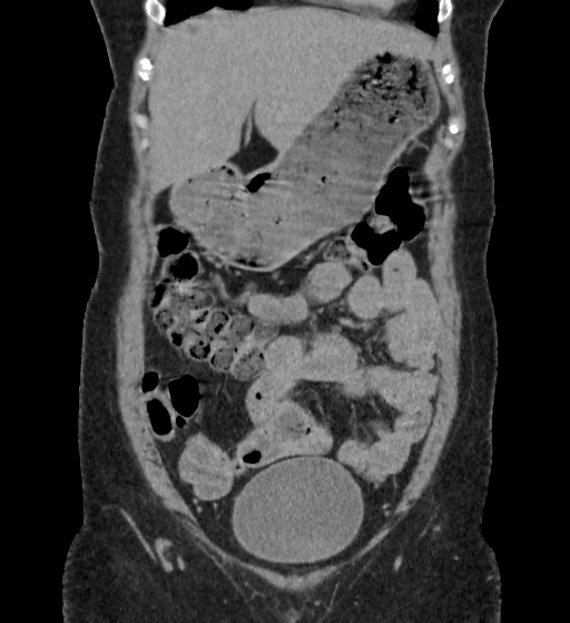 File:Autosomal dominant polycystic kidney disease (Radiopaedia 38189-40194 Coronal C+ delayed 11).jpg