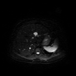 Autosomal dominant polycystic kidney disease (Radiopaedia 50259-55611 Axial DWI 10).jpg