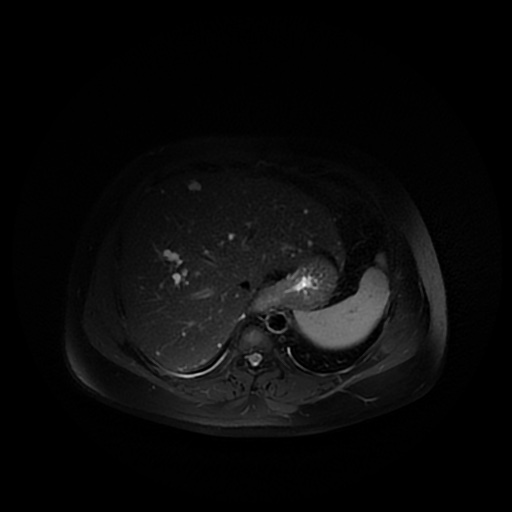 File:Autosomal dominant polycystic kidney disease (Radiopaedia 50259-55611 Axial T2 fat sat 8).jpg
