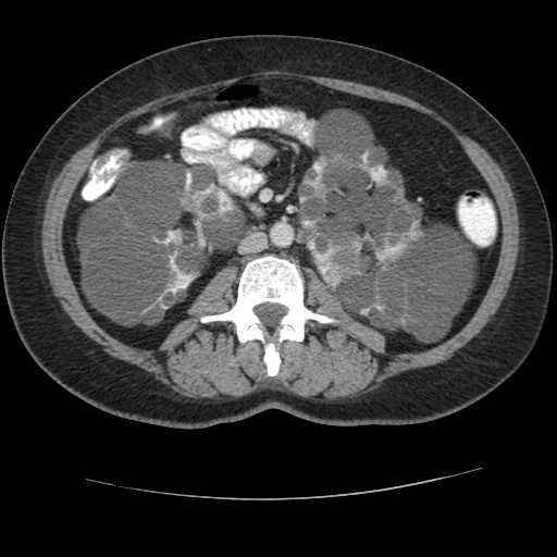 Autosomal dominant polycystic kidney disease with hepatic involvement (Radiopaedia 32693-33662 B 41).jpg