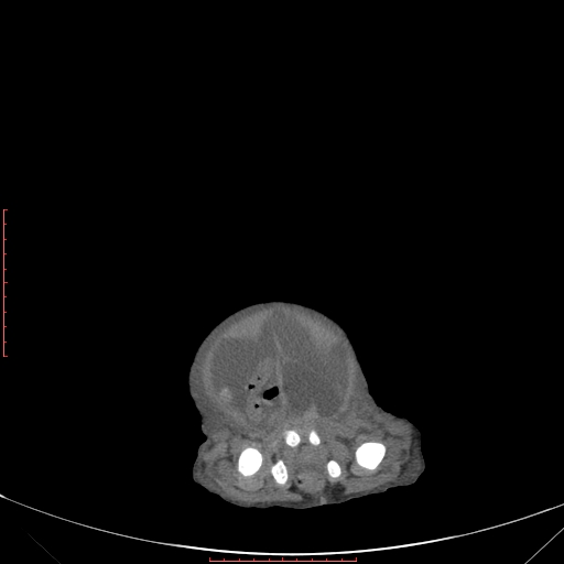 Autosomal recessive polycystic kidney disease associated with Caroli disease (Radiopaedia 61932-69984 B 347).jpg