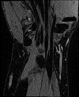 Avascular necrosis of the capitate (Radiopaedia 88317-104948 Coronal T1 vibe 64).jpg