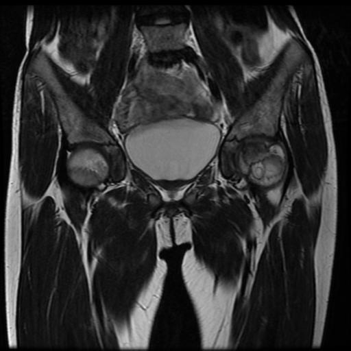 File:Avascular necrosis of the hip (Radiopaedia 29563-30067 Coronal T2 5).jpg