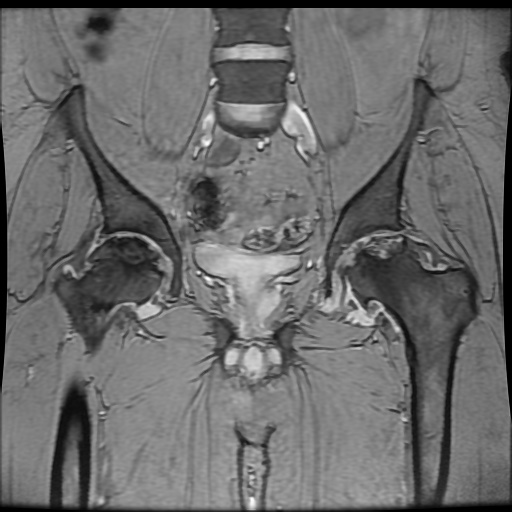 Avascular necrosis of the hip (Radiopaedia 61503-69465 F 43).jpg