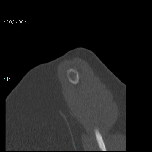 Avascular necrosis of the shoulder - Cruess stage I (Radiopaedia 77674-89887 Sagittal bone window 89).jpg