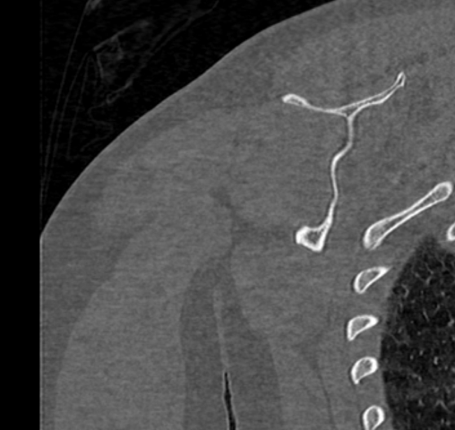 Avulsion fracture - greater tuberosity of humerus (Radiopaedia 71216-81514 Coronal bone window 66).jpg