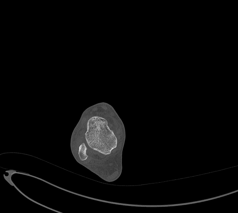 Avulsion fractures of talus and calcaneus (Radiopaedia 48277-53155 Axial bone window 20).jpg