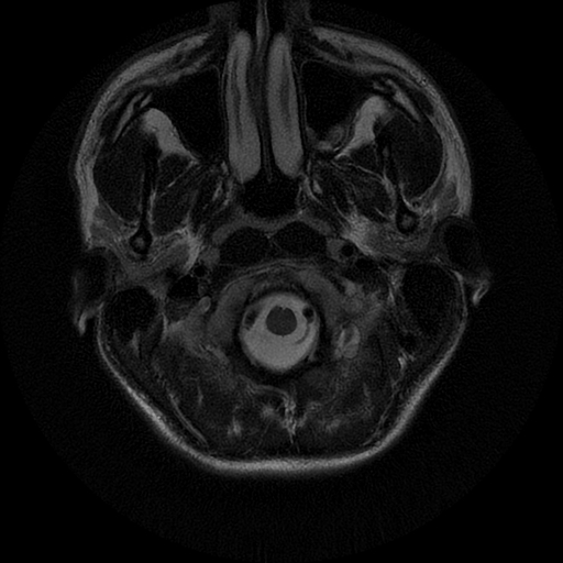 File:Azygos anterior cerebral artery (Radiopaedia 17059-16756 Axial T2 24).jpg