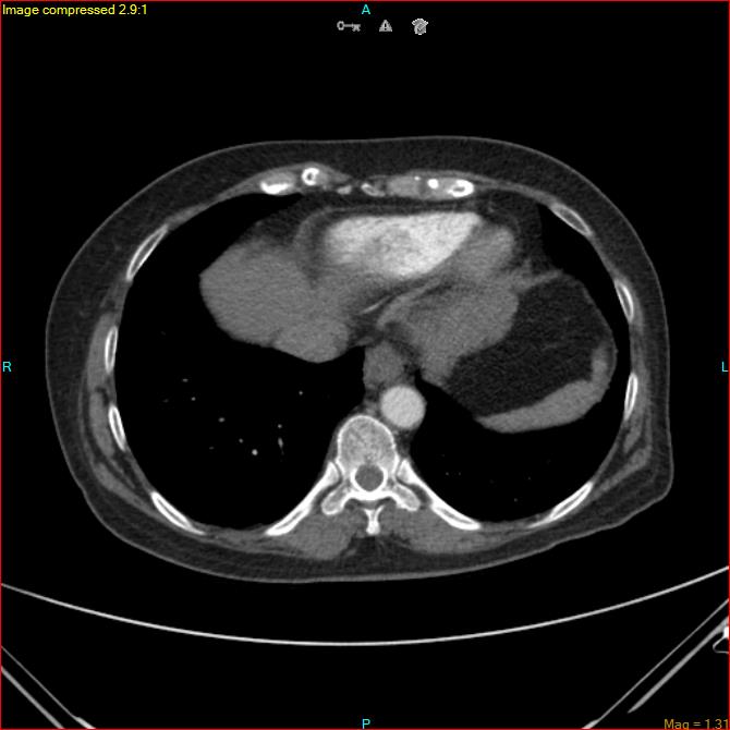 Azygos vein aneurysm (Radiopaedia 77824-90130 B 43).jpg