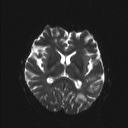 Balo concentric sclerosis (Radiopaedia 50458-55940 Axial DWI 11).jpg