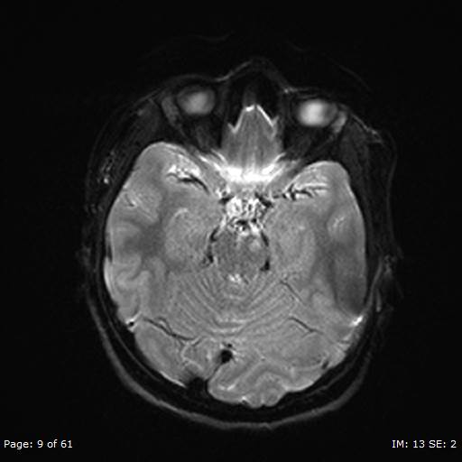 File:Balo concentric sclerosis (Radiopaedia 61637-69636 Axial DWI 9).jpg