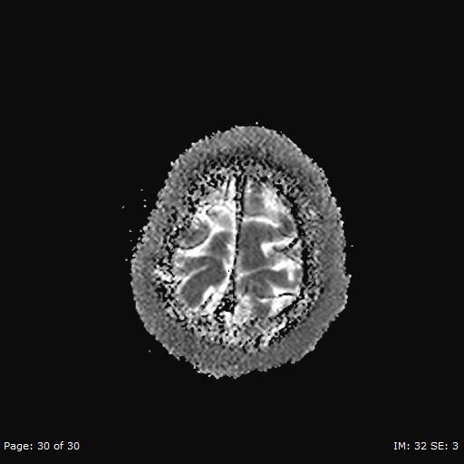 Balo concentric sclerosis (Radiopaedia 61637-69636 I 200).jpg