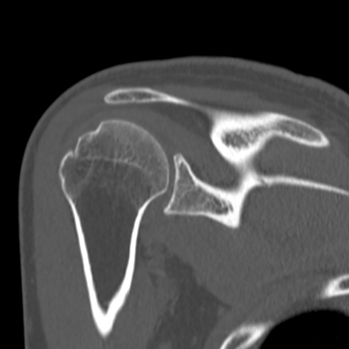 Bankart lesion (Radiopaedia 57256-64185 Coronal bone window 30).jpg