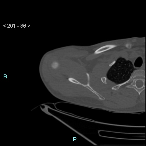 File:Bankart lesion with glenoid bone defect - assessment TC with PICO method (Radiopaedia 42855-93901 Axial bone window 35).jpg