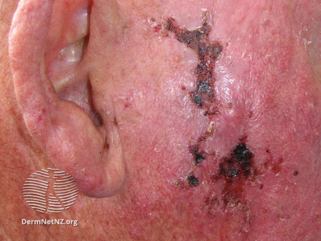 File:Basal cell carcinoma affecting the face (DermNet NZ lesions-bcc-face-0681).jpg