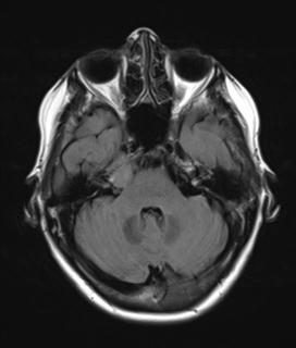 File:Base of skull chondrosarcoma (Radiopaedia 30410-31070 Axial FLAIR 6).jpg