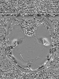 Base of skull chondrosarcoma (Radiopaedia 30410-31070 Axial SWI Phase 19).jpg