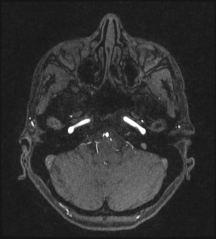 Basilar artery perforator aneurysm (Radiopaedia 82455-97733 Axial MRA 54).jpg