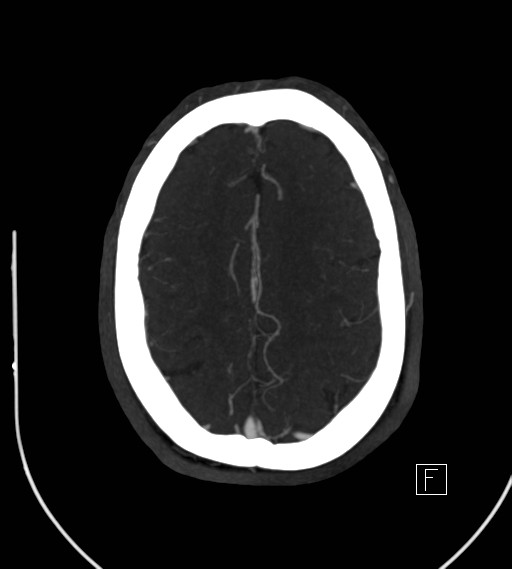 Basilar artery thrombosis (Radiopaedia 26986-27163 A 66).jpg