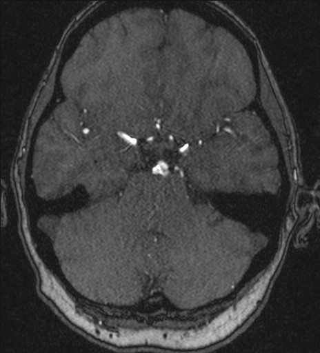 Basilar tip aneurysm (Radiopaedia 26504-26632 MRA 71).jpg