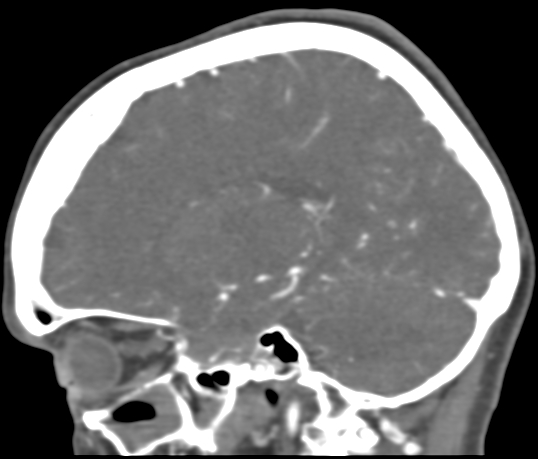 File:Basilar tip aneurysm with coiling (Radiopaedia 53912-60086 C 85).jpg