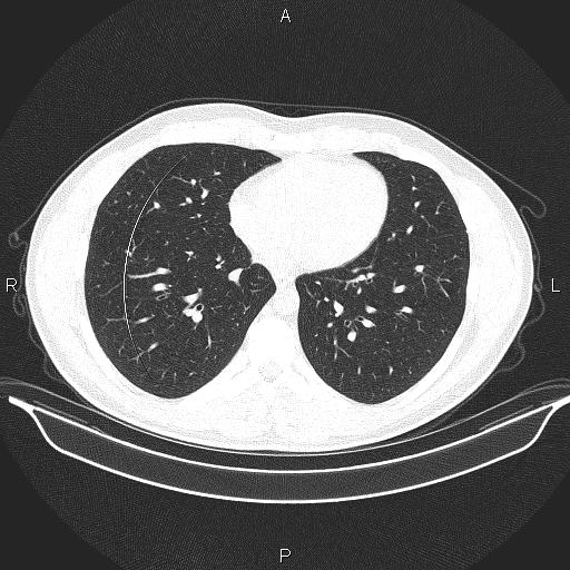 Beam hardening and ring artifacts (Radiopaedia 85323-100915 Axial lung window 51).jpg
