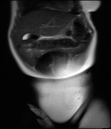 File:Beckwith-Wiedeman syndrome with bilateral Wilms tumors (Radiopaedia 60850-69233 Coronal T2 6).jpg