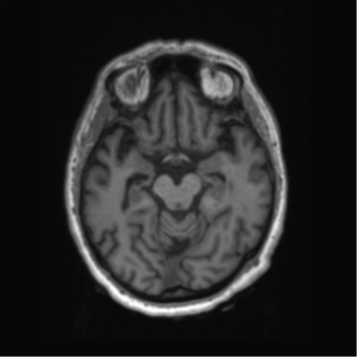 File:Behavioral variant frontotemporal dementia and late onset schizophrenia (Radiopaedia 52197-58083 Axial T1 65).png