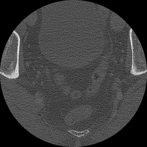 Benign post-traumatic pseudopneumoperitoneum (Radiopaedia 71199-81495 Axial bone window 317).jpg