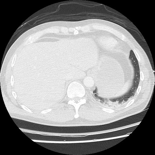 Benign post-traumatic pseudopneumoperitoneum (Radiopaedia 71199-81495 Axial lung window 61).jpg