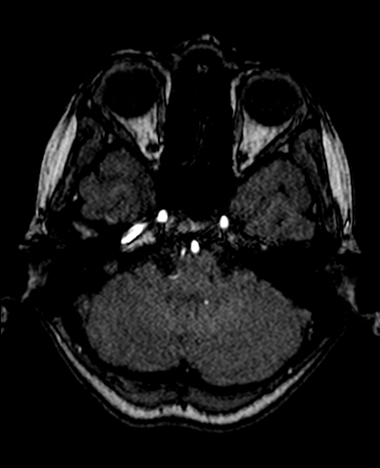 File:Berry aneurysm of the terminal internal carotid artery (Radiopaedia 88286-104918 Axial TOF 70).jpg