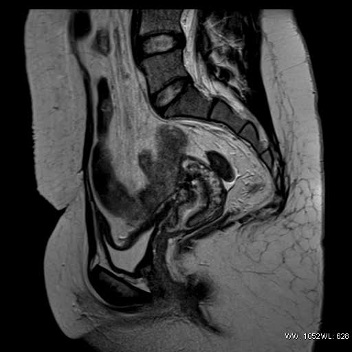 File:Bicornuate uterus- on MRI (Radiopaedia 49206-54297 Sagittal T2 15).jpg