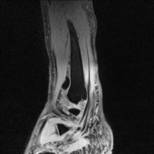 Bilateral Achilles tendon complete tear (Radiopaedia 81344-95051 Sagittal WE - Left 90).jpg