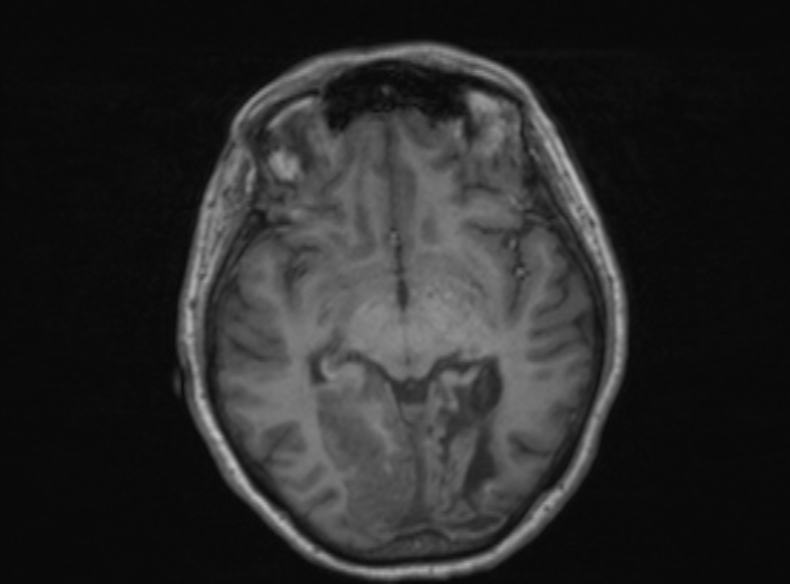 Bilateral PCA territory infarction - different ages (Radiopaedia 46200-51784 Axial T1 254).jpg