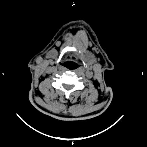 Bilateral Warthin tumors (Radiopaedia 84034-99263 Axial non-contrast 35).jpg