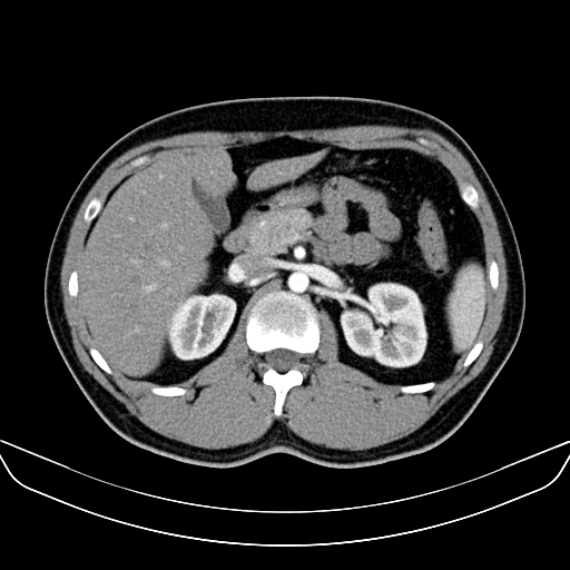 Bilateral accessory renal arteries with mild pelvi-ureteric junction (PUJ) obstruction (Radiopaedia 66357-75596 A 18).jpg
