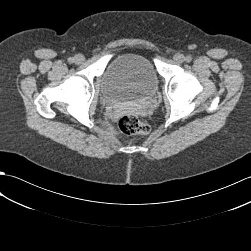 File:Bilateral acetabular protrusion with pincer type femoro-acetabular impingement (Radiopaedia 30134-30733 AXIAL SOFT THIN 50).jpg
