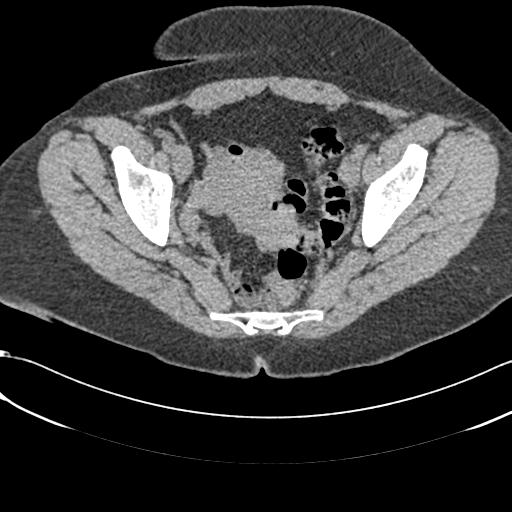 File:Bilateral acetabular protrusion with pincer type femoro-acetabular impingement (Radiopaedia 30134-30733 AXIAL SOFT THIN 9).jpg