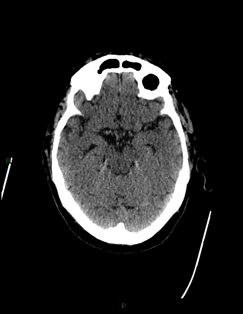 Bilateral acute middle cerebral artery territory infarcts (Radiopaedia 77319-89401 Axial non-contrast 32).jpg