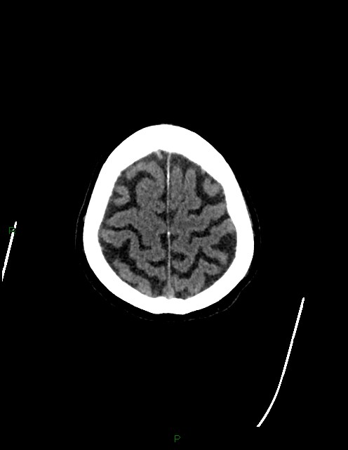 Bilateral acute middle cerebral artery territory infarcts (Radiopaedia 77319-89401 Axial non-contrast 79).jpg